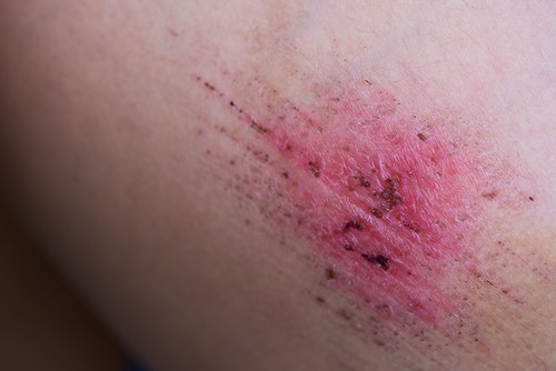 Neosporin là thuốc gì? Công dụng, liều dùng | Bcare.vn